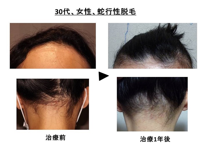 円形脱毛症　病院